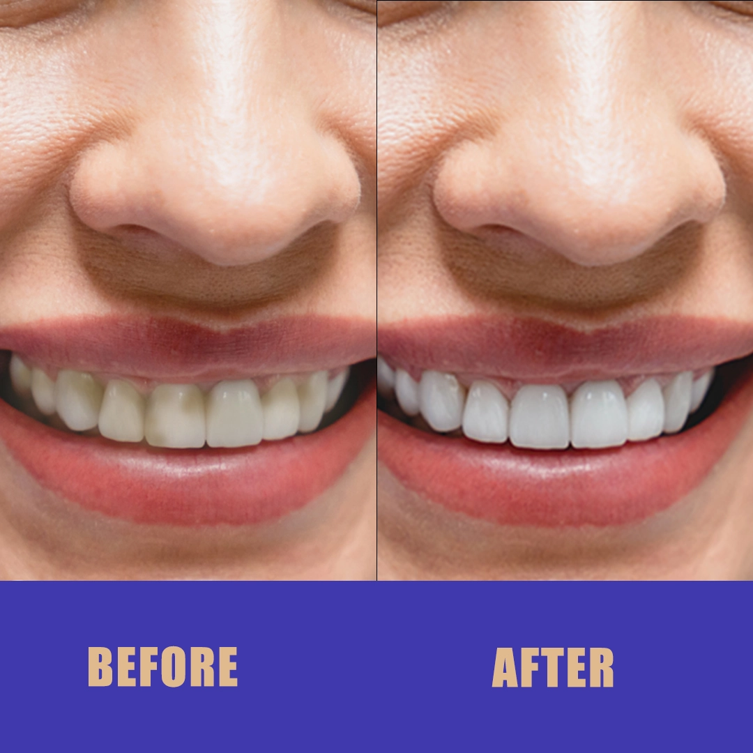 Aftercare Tips Following Your Veneers Process